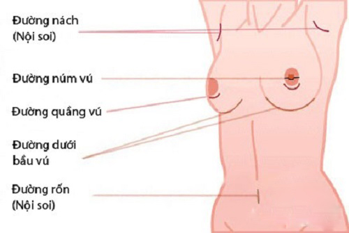 Nâng ngực nội soi qua nhiều đường khác nhau