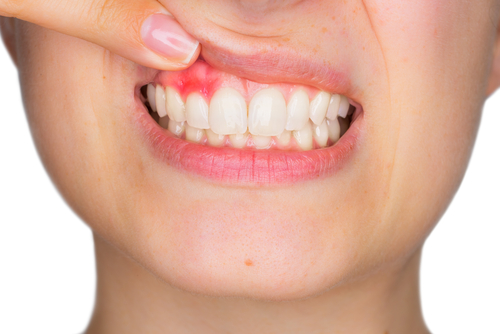 Thiếu vitamin C có thể gây viêm răng, chảy máu răng