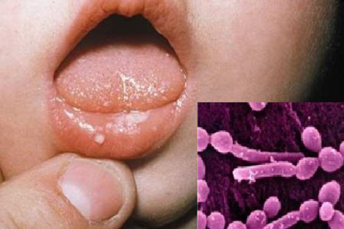 Nấm miệng là gì? Nguyên nhân nào dẫn đến tình trạng nấm miệng?