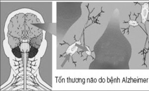 sa sút trí tuệ