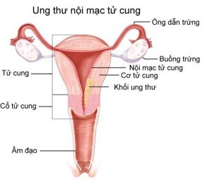 Ung thư nội mạc tử cung