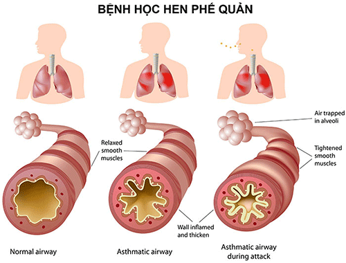 Cơ chế hoạt động của thuốc điều trị bệnh hen suyễn