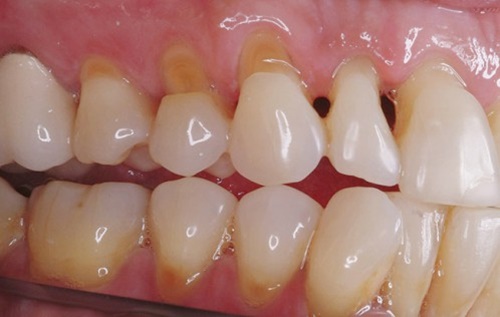Mòn ổ chân răng, một căn bệnh phổ biến ở nhiều người