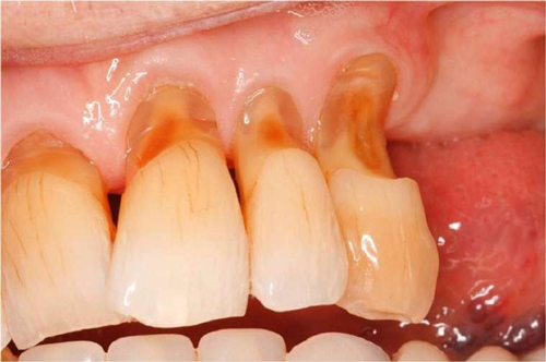 Mòn ổ chân răng để lâu sẽ gây ra hãy răng và một số bệnh lý khác về răng miệng